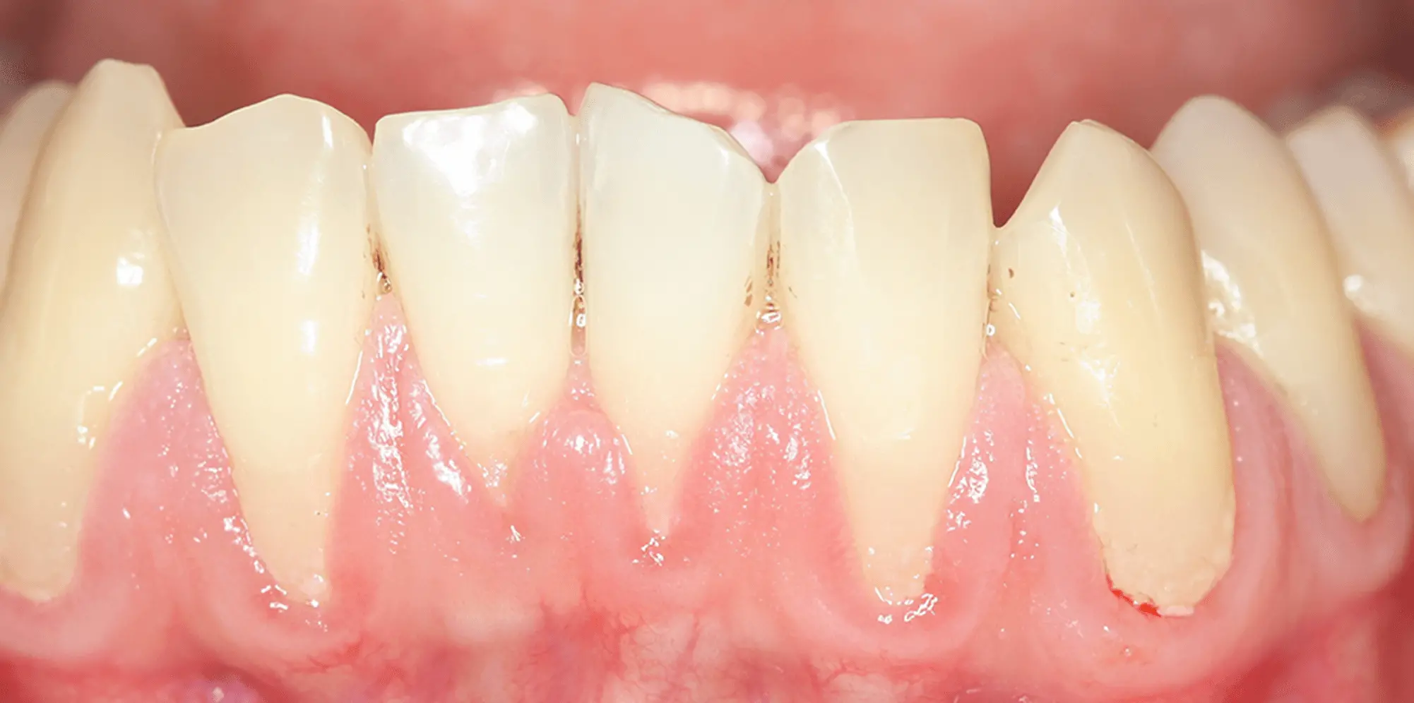 歯周病を患っている歯茎の画像