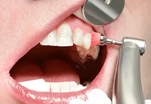 歯をクリーニングしている画像